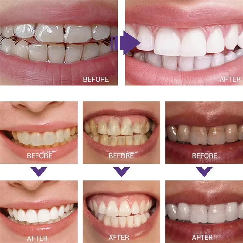 Pasta Gigi Pemutih Pembersih G - Teeth Whitening Korea ulasan dan harga