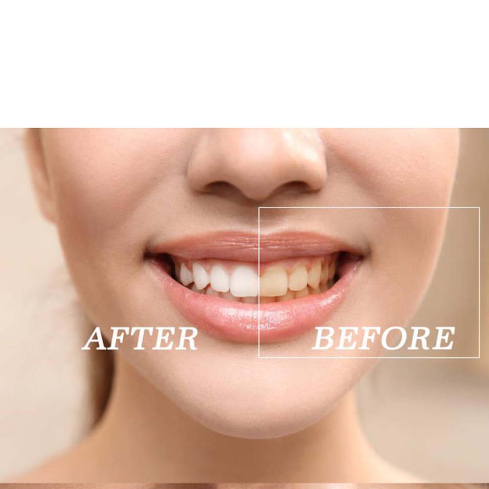Kit Gel pemutih gigi peroksida - Teeth Whitening Gel Peroxide ulasan dan harga